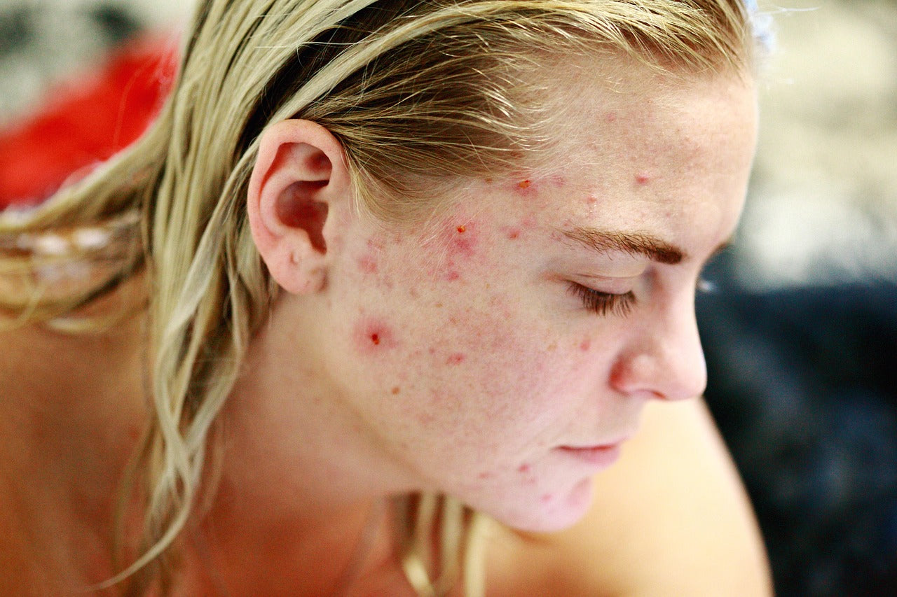 Portrait de femme présentant une acné hormonale visible sur les joues et le front, symptômes fréquents liés aux variations hormonales.