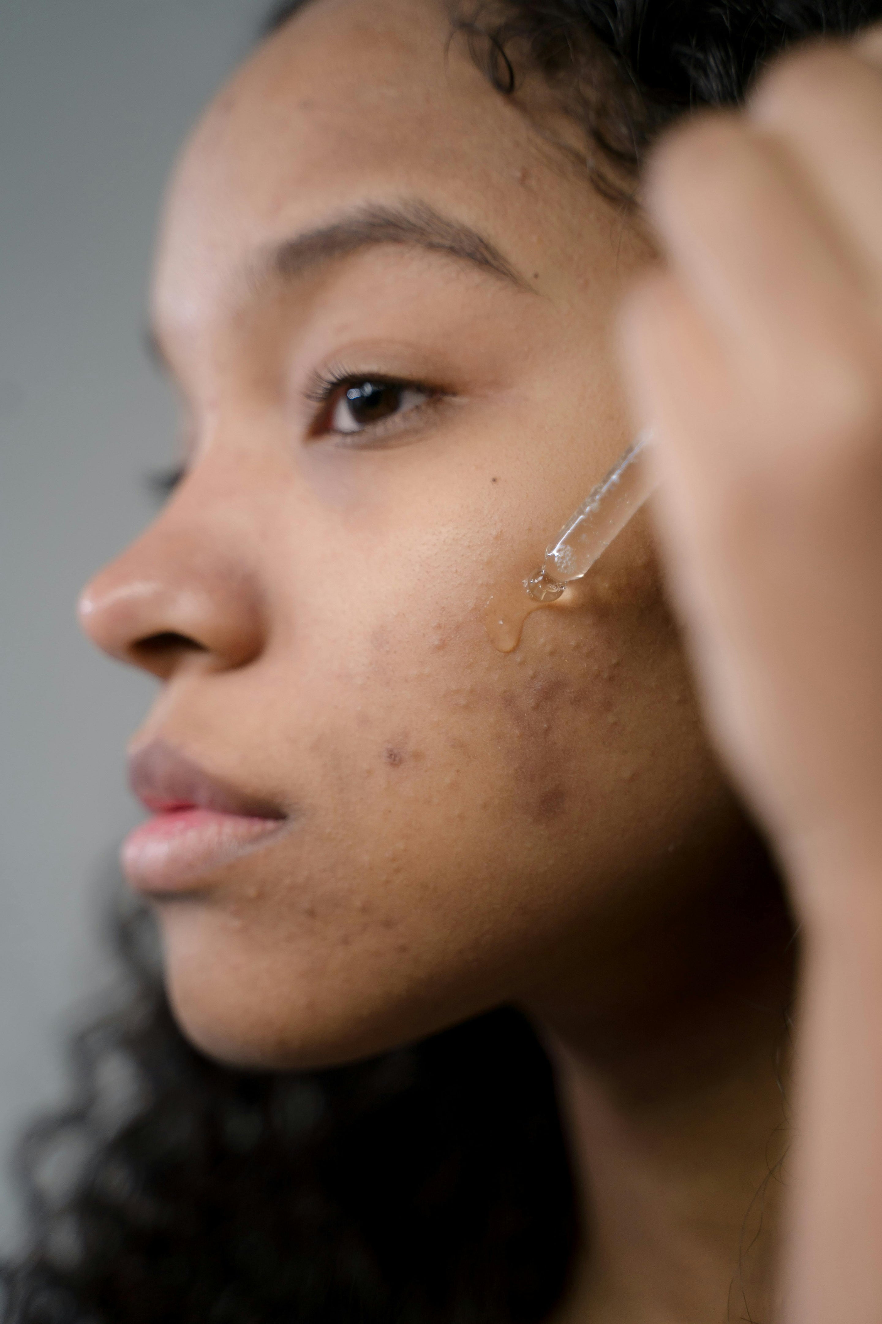 Sérum naturel appliqué sur une peau marquée par des imperfections liées aux variations hormonales.